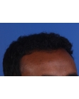After Hair Transplant&nbsp;Front